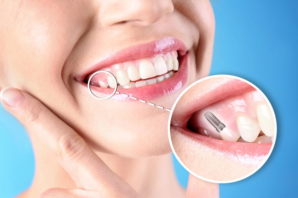 Nose-to-neck view of woman touching cheek smiling with tooth indicated as implant